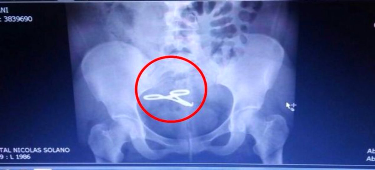 Cuatro años después una mujer descubre que le dejaron una pinza dentro del abdomen en el Hospital Santo Tomás