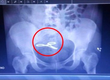 Cuatro años después una mujer descubre que le dejaron una pinza dentro del abdomen en el Hospital Santo Tomás